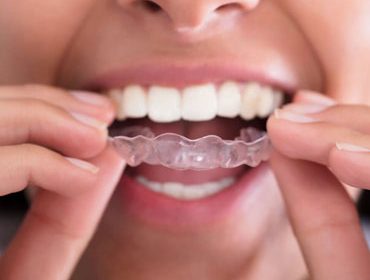 clear aligners to straighten teeth